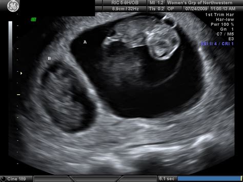 dating scan at 11 weeks 5 days